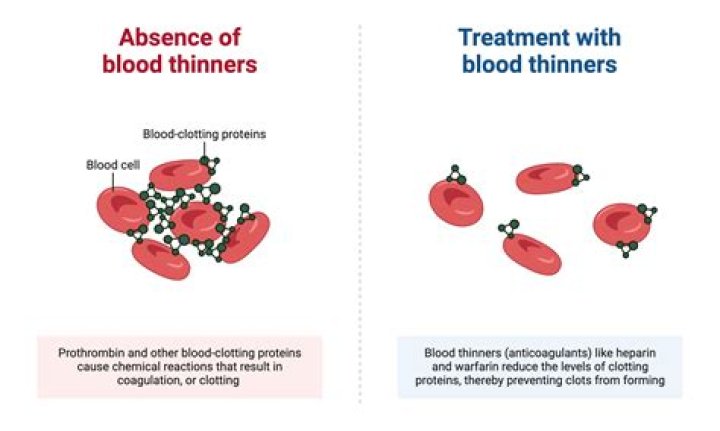 Accumulation that could be prevented by a blood thinner