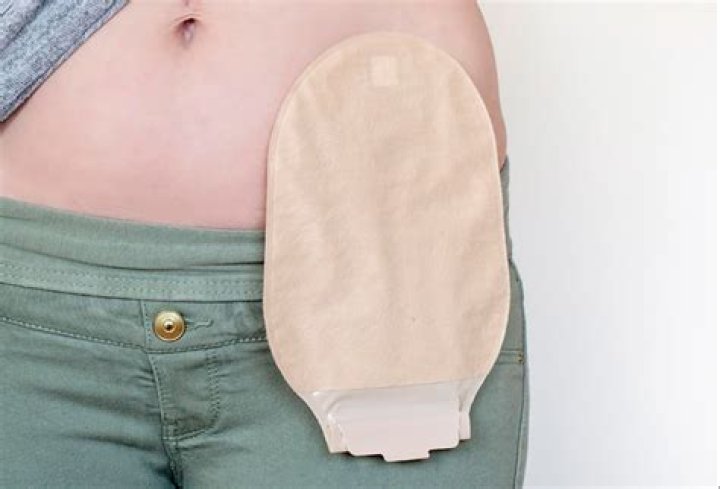 Are colostomy bags permanent?