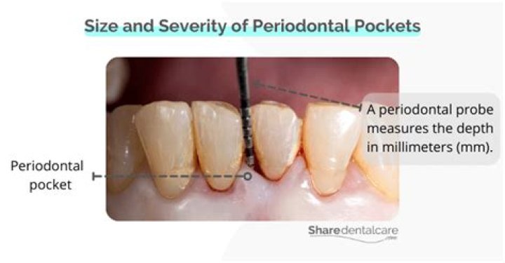 Are periodontal pockets reversible?