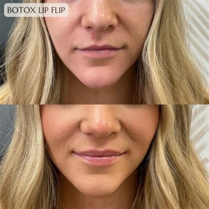 Can Botox fix a downturned mouth?
