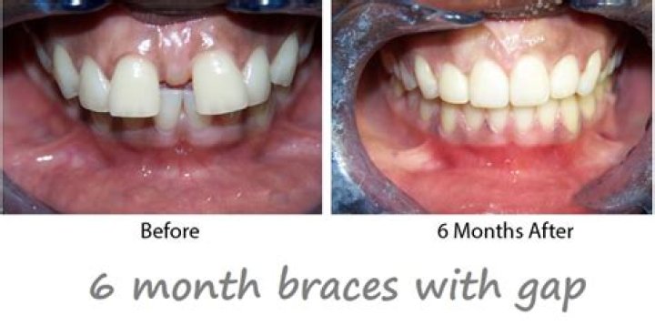 Can braces remove in 6 months?