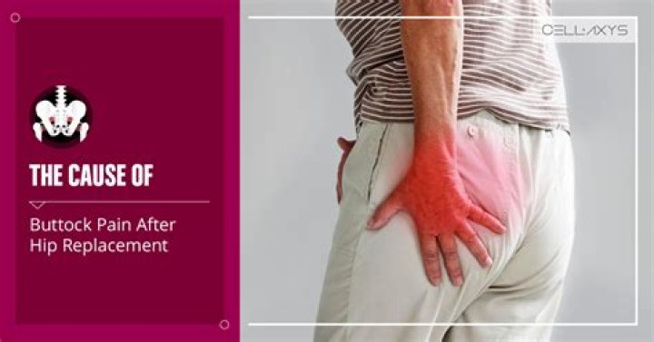 Can fibromyalgia cause buttock pain?