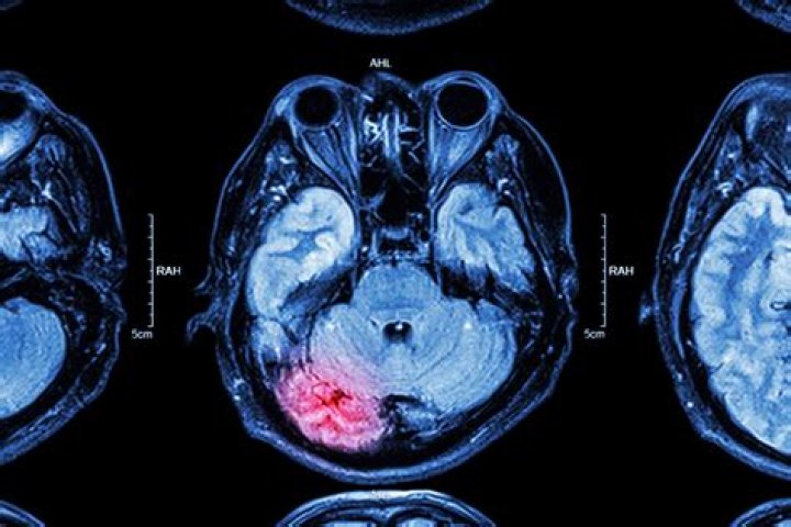 Can TBI affect you years later?