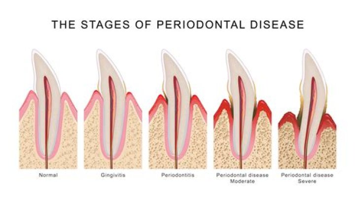 Can you stop the progression of periodontal disease?