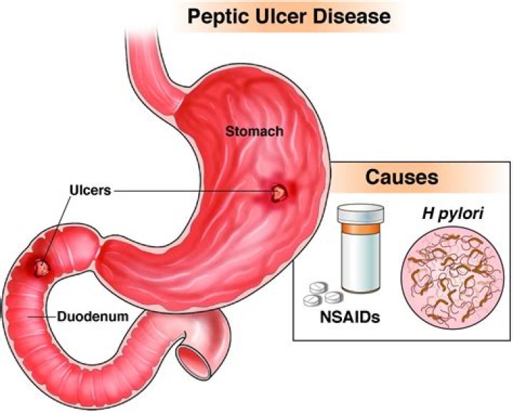 Do I have gastritis or ulcer?