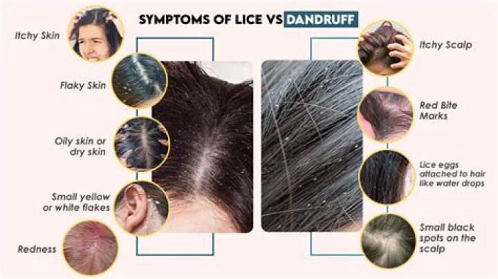 Do lice like dandruff?
