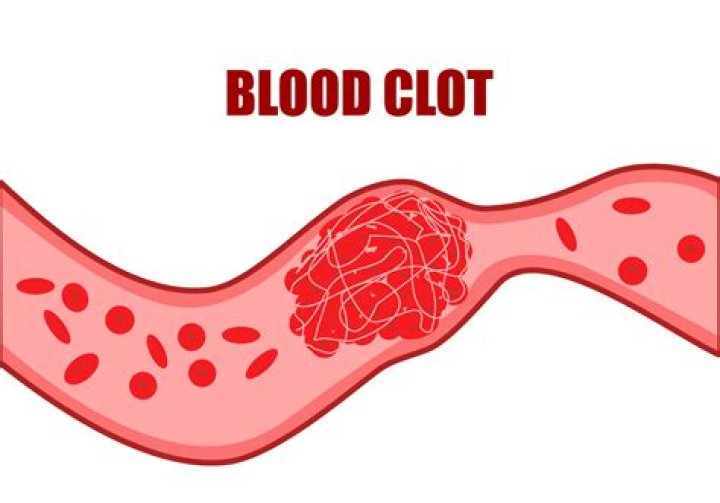 Does a blood clot hurt when you press on it?