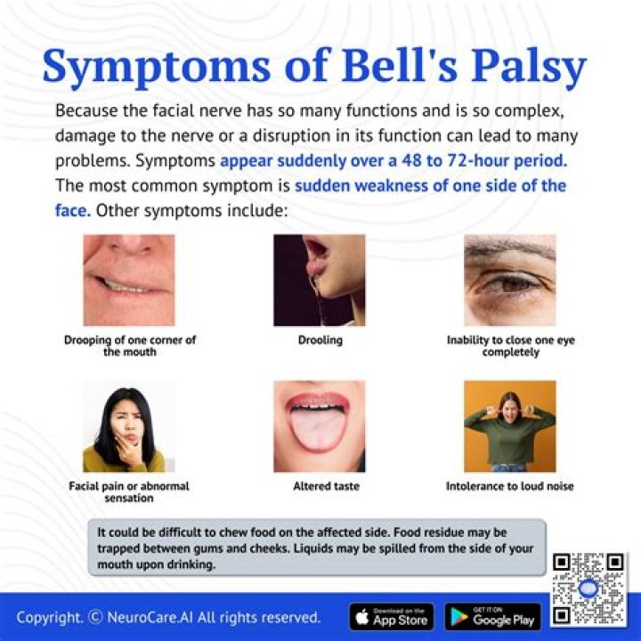 Does Bell's palsy affect your nose?