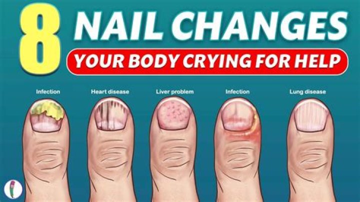 Does diabetes cause yellow nails?