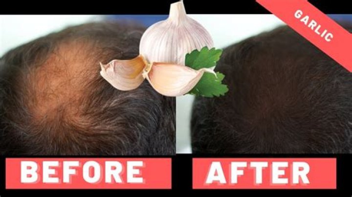 Does garlic help hair growth?