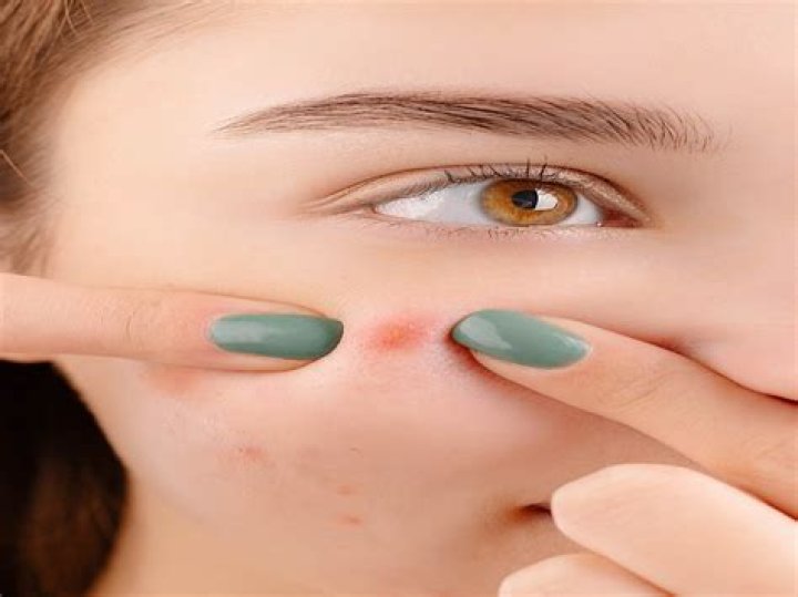 Does ice reduce blind pimples?