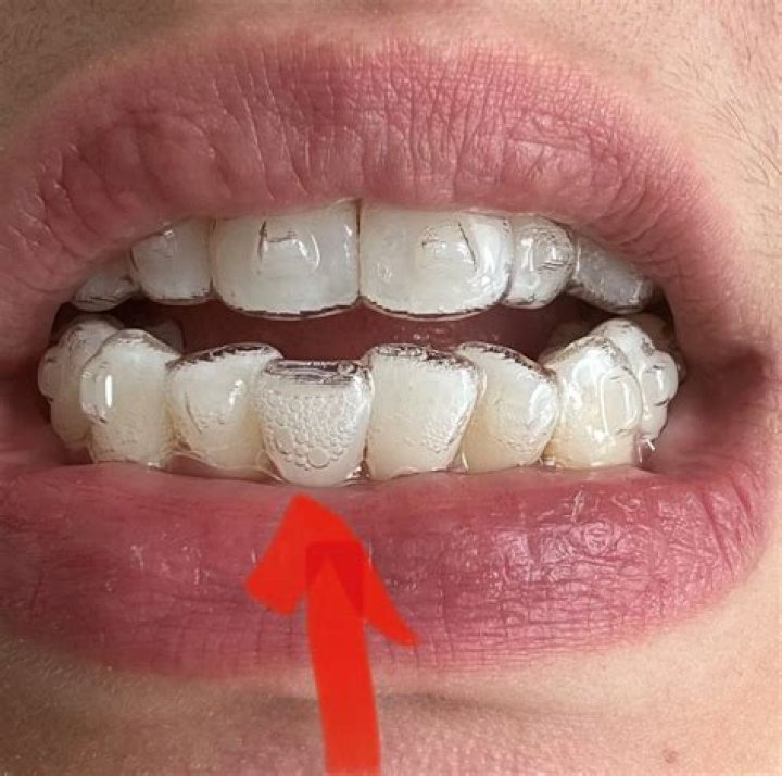 Does Invisalign affect kissing?