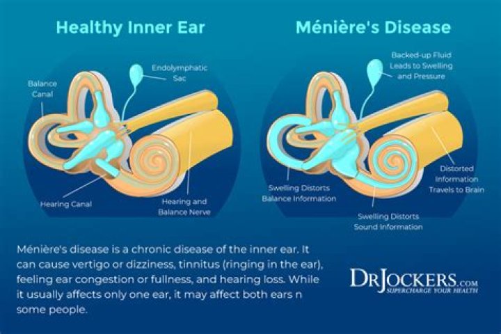 Does Meniere's cause brain damage?