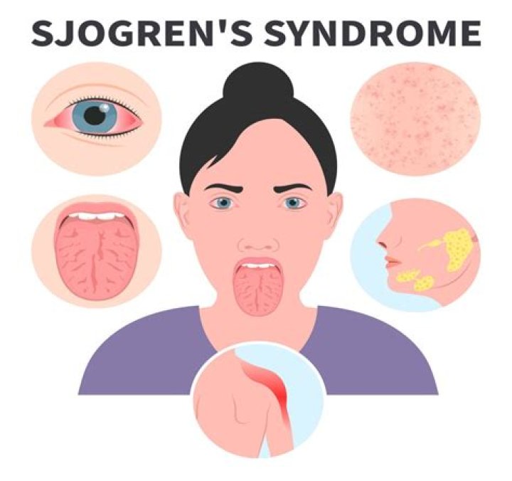 Does sjogrens make you tired?