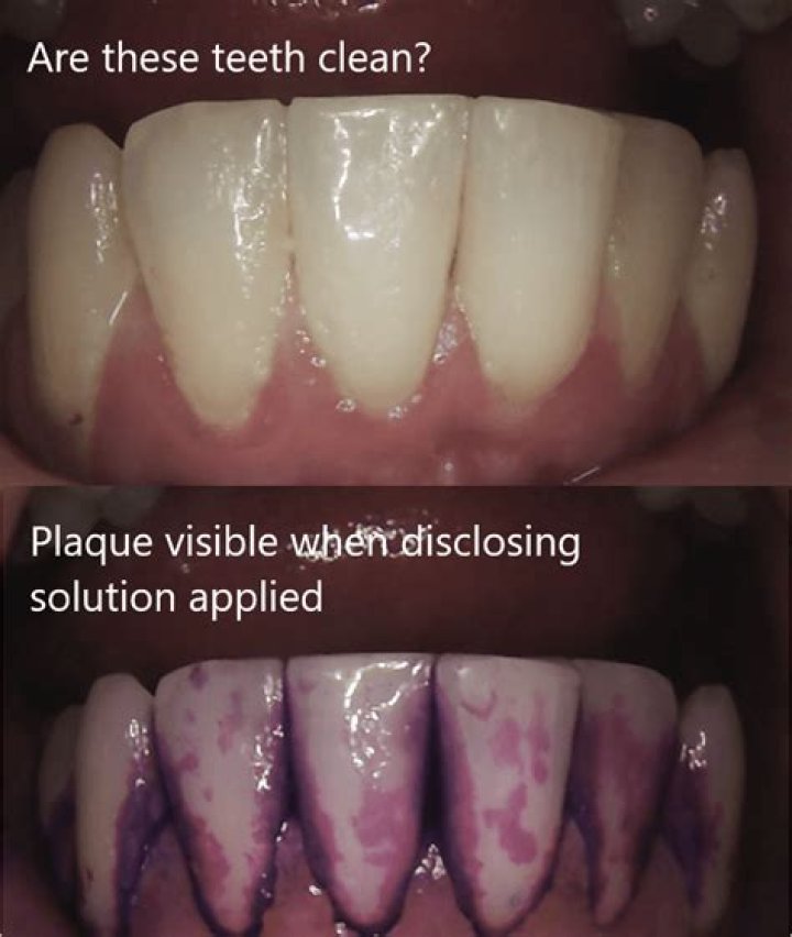 Does vinegar dissolve plaque?