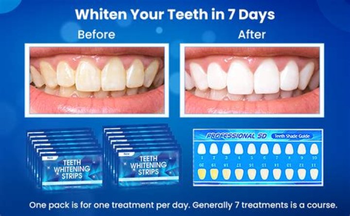 Does whitening toothpaste ruin veneers?