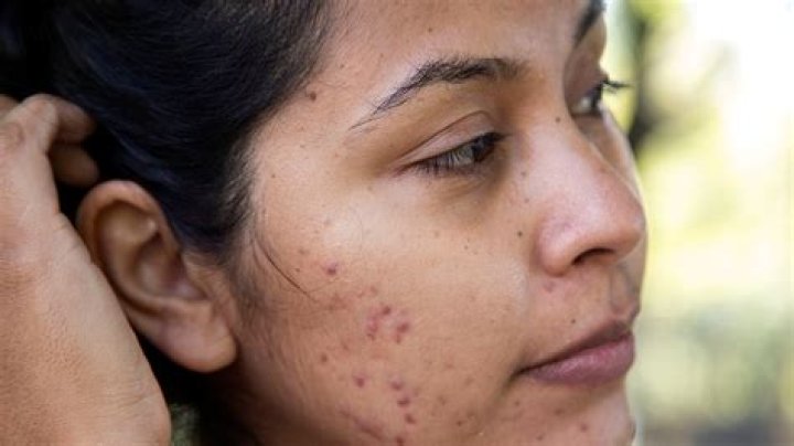 How can a 14 year old get rid of acne?