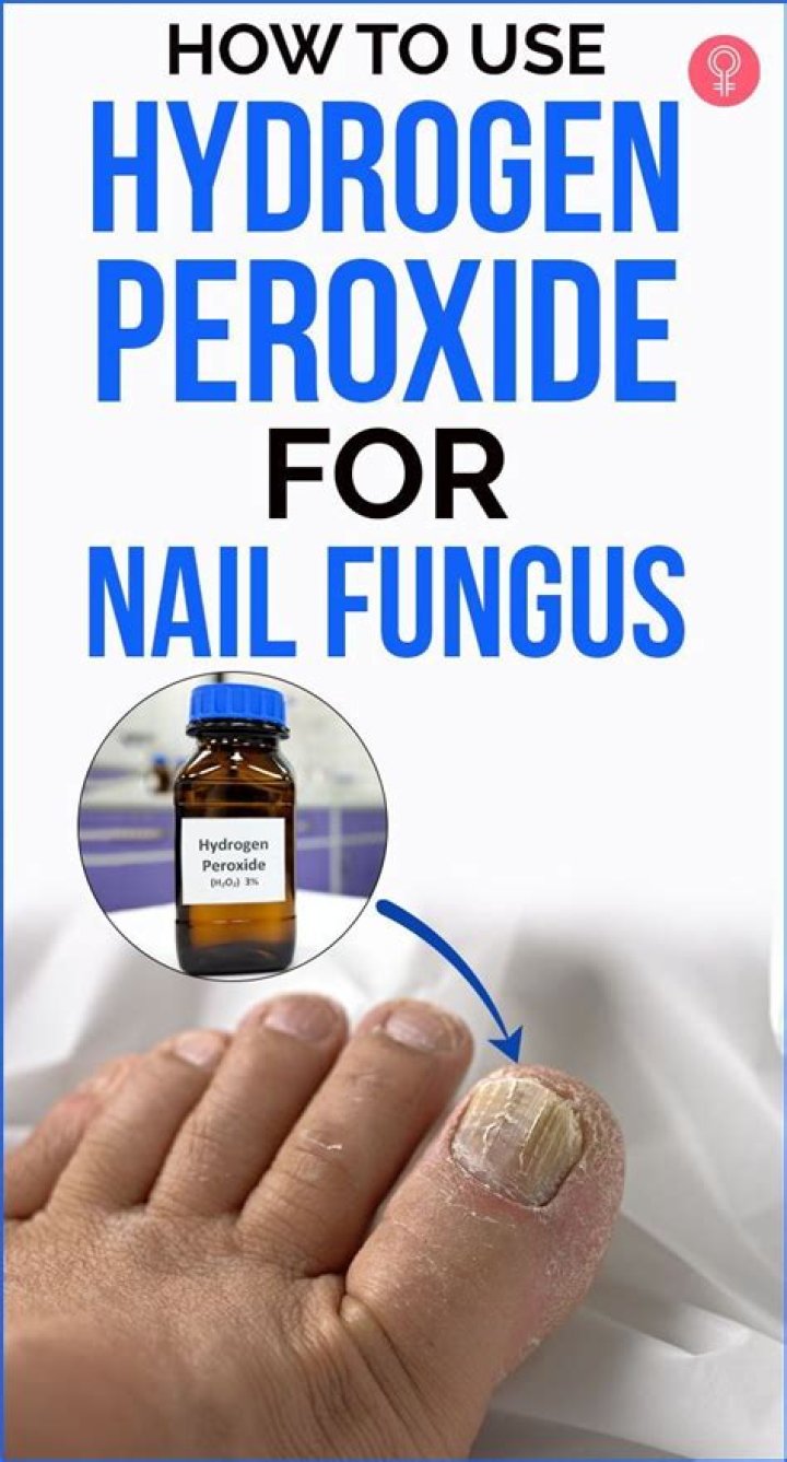 How do you treat toenail fungus with hydrogen peroxide?