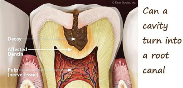 How long can you let a cavity go?