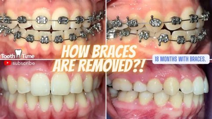 How long does brace removal take?