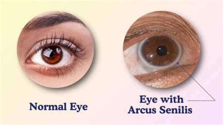 Is arcus senilis serious?