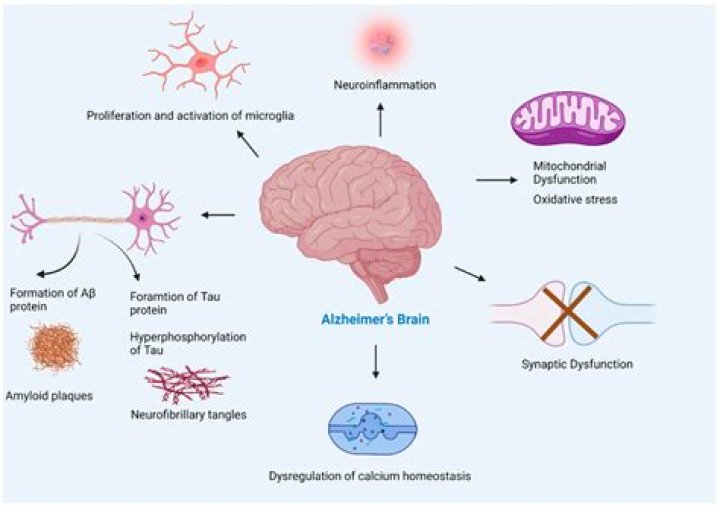 Is hearing loss linked to Alzheimer's?