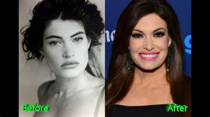 Kimberly Guilfoyle Surgery: Understanding the Procedure and Its Impact