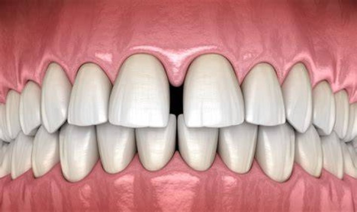 Spaces between teeth