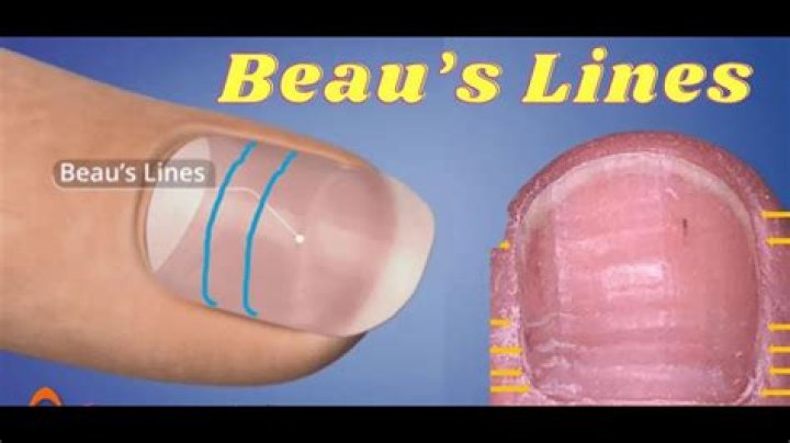 What are Beau's lines?