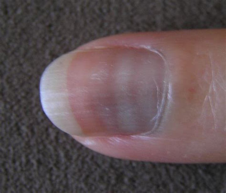 What are Mees lines?