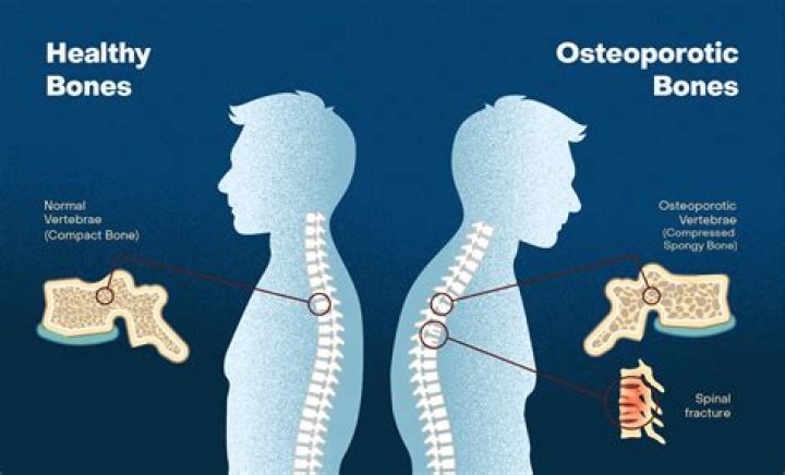 What benefits can I claim if I have osteoporosis?