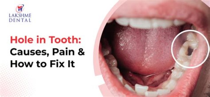 What can I use to fill a hole in my tooth?
