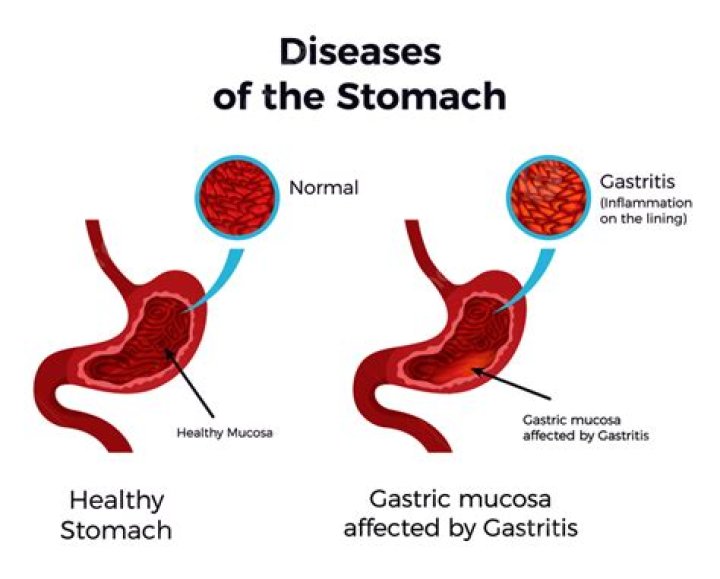 What causes gastric fold thickening?