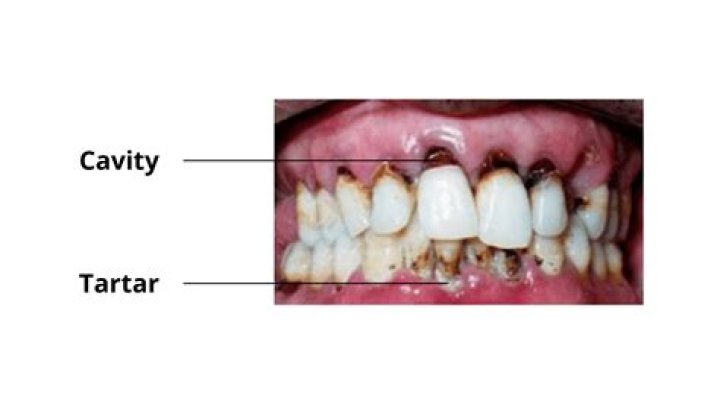 What color is dental tartar?