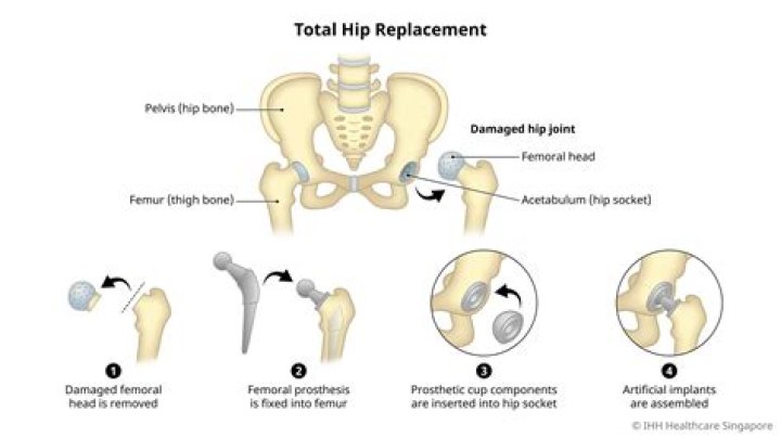 What do crematoriums do with artificial joints?