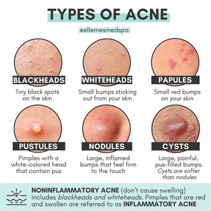 What does a cystic pimple look like?