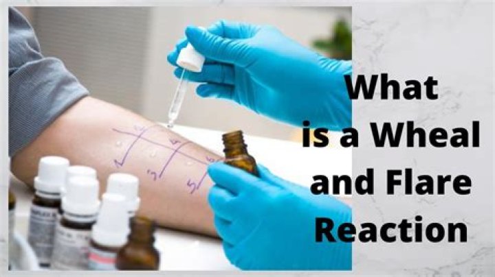What is a Wheal meaning?