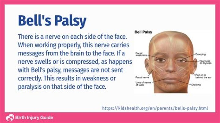 What is the acute stage of Bell's palsy?
