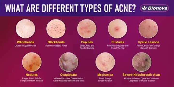 What is the best way to get rid of teenage acne?
