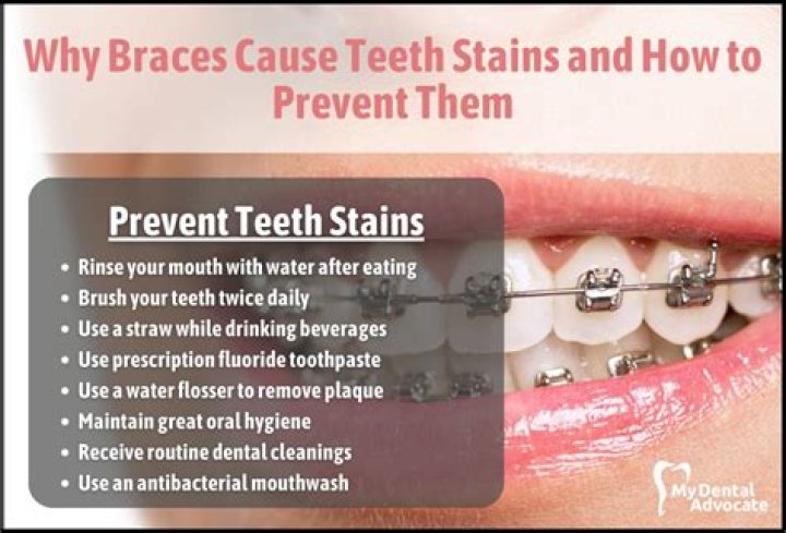What is the fastest way to remove braces stains?