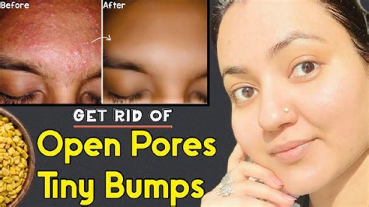 What is the hard yellow stuff that comes out of pores?