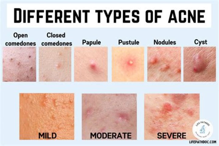 What is yellow fat acne?