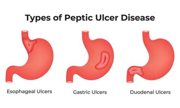 What organs are affected by ulcers?