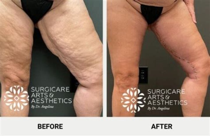 Where do they cut for thigh lift?