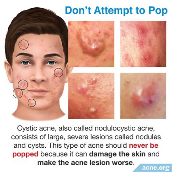 Why does my pimple keep coming back after I pop it?